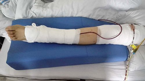 极悦注册C-012-03下肢抬高垫临床使用效果组图 极悦注册C-012-03下肢抬高垫临床使用效果组图